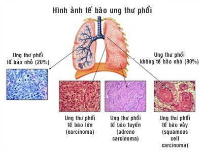 Ung thư phổi và giai đoạn phát triển