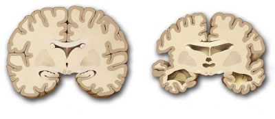 Bệnh teo não giai đoạn và diễn biến bệnh