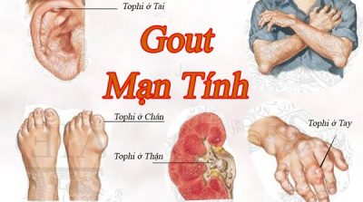 Cách chữa bệnh gout bằng thuốc đông y 