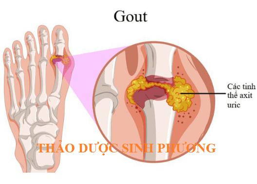Cách chữa bệnh gout