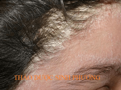 Bệnh Nấm Da Đầu – Chữa Bằng Cách Nào?