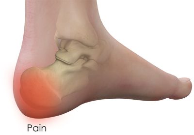 Cách chữa đau gót chân bằng phương pháp dân gian hiệu quả