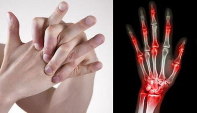 Hành động có hại cho xương khớp như bẻ các khớp tay